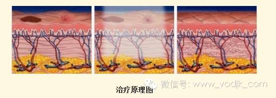 你和牛奶肌之间只差一道光，光子嫩肤到底有多神奇？