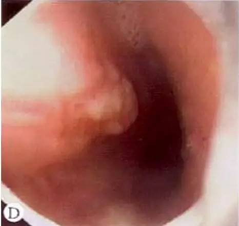 食管癌早期筛查手段,早期食管癌内镜的切除方式有哪些