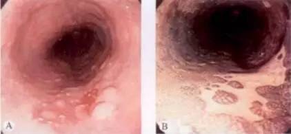 食管癌早期筛查手段,早期食管癌内镜的切除方式有哪些