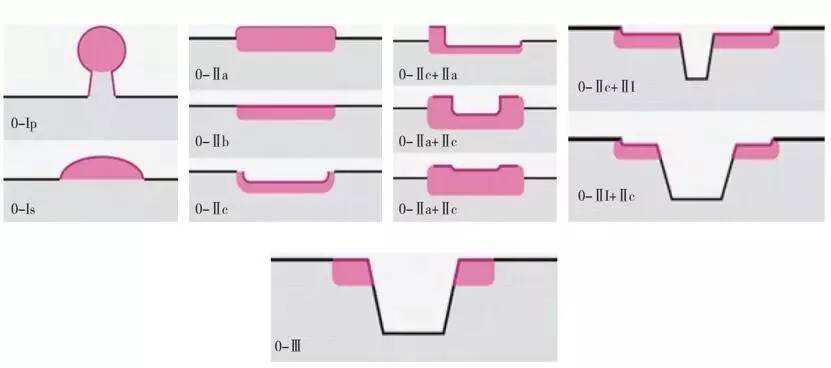 食管癌早期筛查手段,早期食管癌内镜的切除方式有哪些