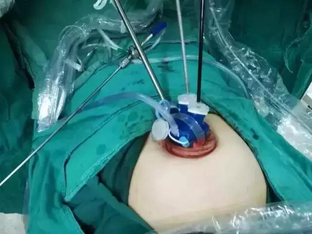 经脐单孔腹腔镜术后伤口“了无痕”