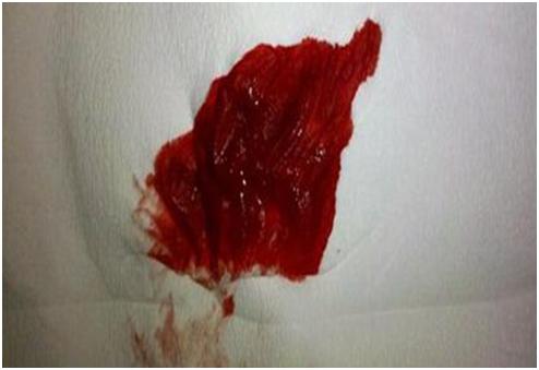 医生自己应对痔疮的秘技