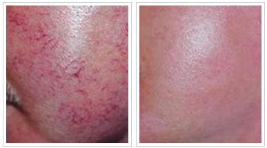 遗传性红血丝怎么祛除,遗传性的红血丝可以彻底祛除吗