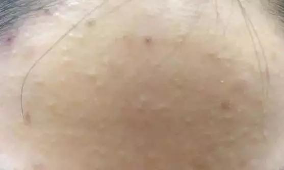 脸上老长闭合性粉刺是什么原因,脸上老是长闭合性粉刺是怎么回事