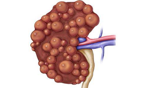 出现血尿一定要提高警惕,iga肾病无症状镜下血尿