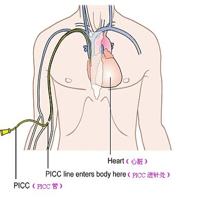 picc药物堵管的原因不包括,双腔picc堵管怎么办