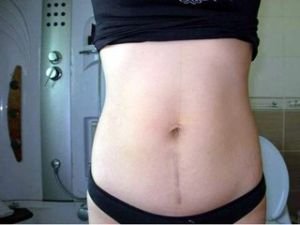 什么人不建议剖腹产,哪些人更适合剖腹产