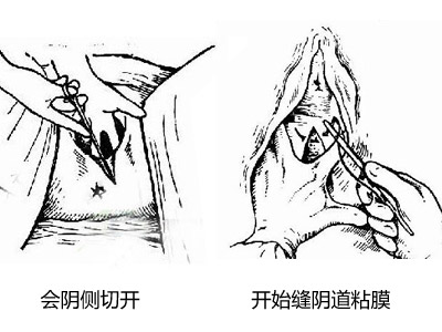 顺产外阴侧切和竖切有什么区别,顺产侧切还是挨刀好