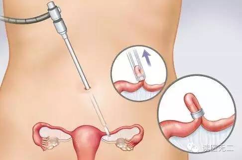 第四代避孕药怎么样,第4代避孕药有哪些