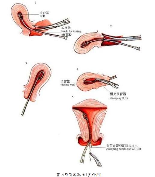 你被逼上环了吗？女性上环全过程，简直就像命案现场！