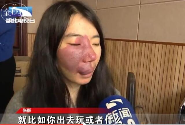 洪湖“胎记女生”考研复试遭淘汰忍痛接受治疗