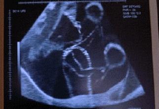 宝宝缺氧胎动是什么样的,宝宝缺氧胎动是怎样的