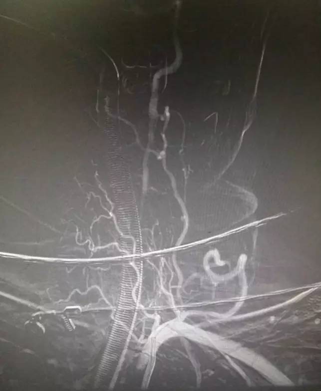 市人民医院取栓手术的全过程,病例分享视频素材