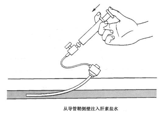 超声引导下改良塞丁格技术解剖图,超声引导下pdca置管