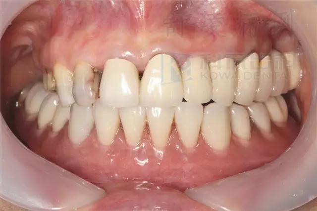 活动假牙戴不住，种植牙又嫌贵该怎么办？