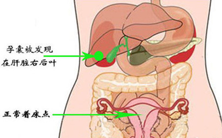 胎儿长在肝上,长在肝脏里的胎儿
