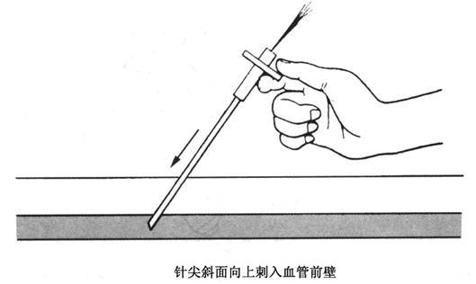 超声引导下改良塞丁格技术解剖图,超声引导下pdca置管