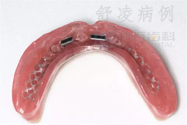 活动假牙戴不住，种植牙又嫌贵该怎么办？