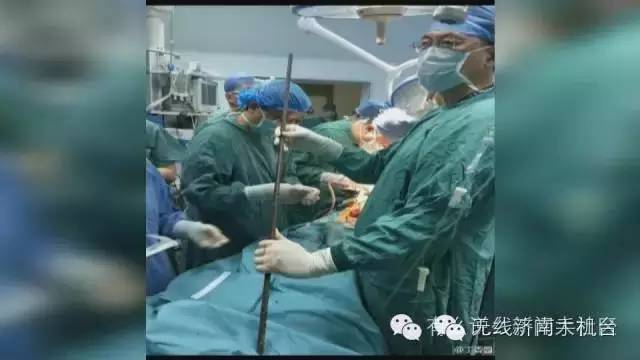 济南男子被1米长钢筋从阴部穿到脑部30名专家开颅开胸开腹手术7小时保住命