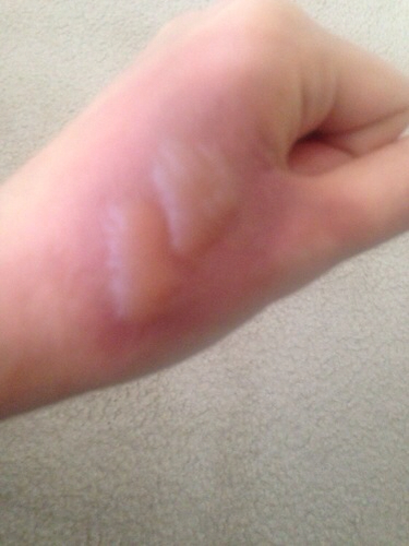 不小心被开水烫了能用冷水冲吗,不小心被开水烫到了怎么处理