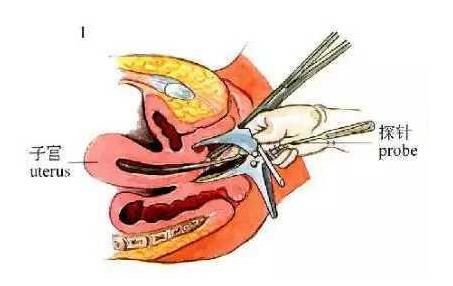 取环手术全过程（附图）