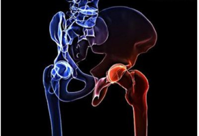股骨头坏死——大腿根部、内侧疼痛的特点