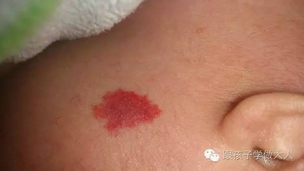 宝宝长雀斑样痣,宝宝长这种痣千万要注意