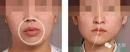 缺一颗门牙能戴隐形牙套吗,门牙龅牙医生建议磨小戴牙套