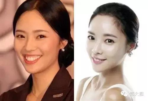 缺一颗门牙能戴隐形牙套吗,门牙龅牙医生建议磨小戴牙套