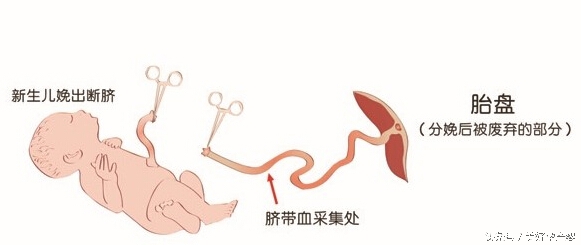 脐带血要不要留,脐带血究竟要不要保留