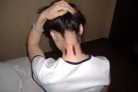 中暑分体质吗,中暑怎么区分阴阳