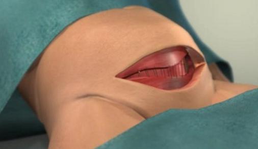 38岁产妇剖腹产经历,剖腹产38周宫缩是什么原因