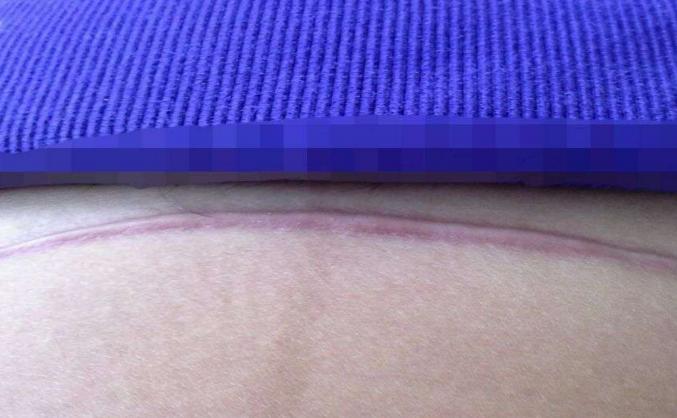 38岁产妇剖腹产经历,剖腹产38周宫缩是什么原因