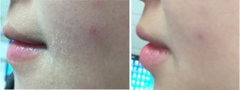 英树透明质酸保湿肌底液收缩毛孔,英树透明肌肤保湿液