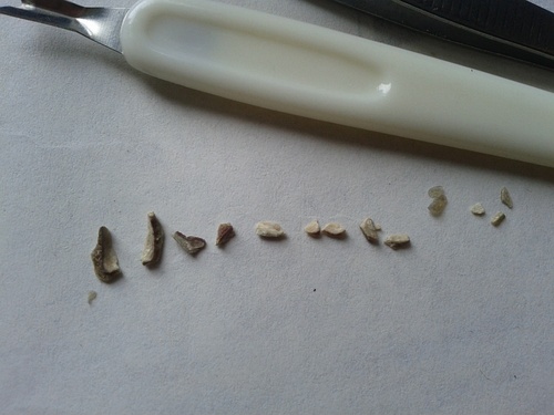 牙结石为什么用手抠不掉,自己抠牙结石能抠干净吗