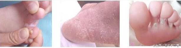 男性14岁趾间糜烂型脚气脱皮现象,脚上脱皮水泡痒脚趾缝溃烂