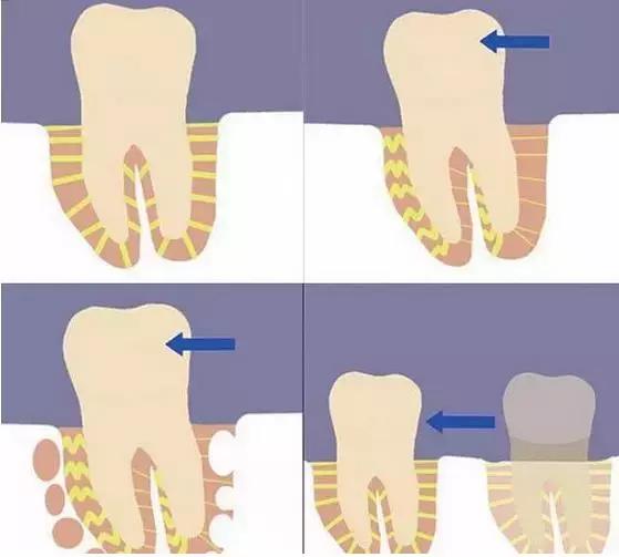 牙齿矫正是拔牙多好还是少好,为什么牙齿矫正一般都要拔牙