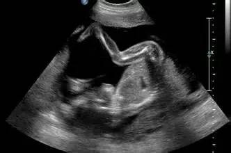 胎儿11-14周心室检查超声图片,12-14周孕期检查重要项目