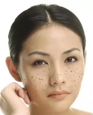 如何去除斑点小方法,手臂斑点去除的最好方法