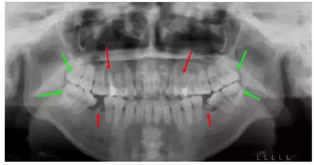 牙齿矫正是拔牙多好还是少好,为什么牙齿矫正一般都要拔牙