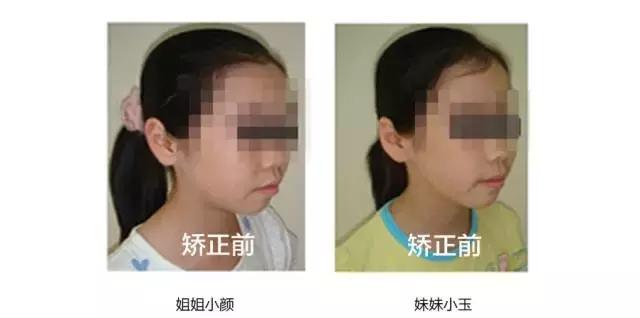 牙齿矫正是拔牙多好还是少好,为什么牙齿矫正一般都要拔牙