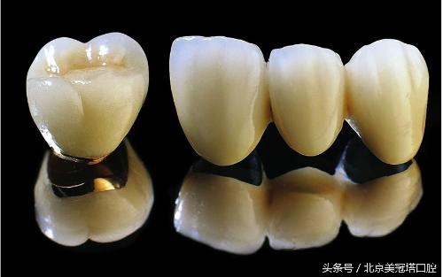 镶一口烤瓷牙到底好不好,镶的烤瓷牙有什么不习惯的吗