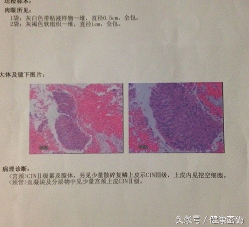 子宫检查报告单如何看,妇科子宫颈刮片是怎么检查的