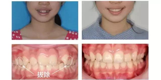 牙齿矫正是拔牙多好还是少好,为什么牙齿矫正一般都要拔牙