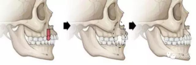牙齿矫正是拔牙多好还是少好,为什么牙齿矫正一般都要拔牙