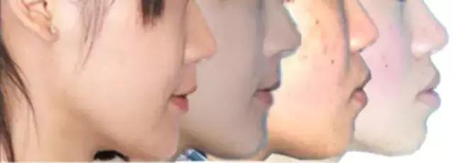 牙齿矫正是拔牙多好还是少好,为什么牙齿矫正一般都要拔牙