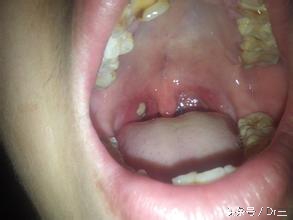 胃胀打嗝胸闷气短放屁吃啥药,吃完饭就胃胀打嗝胸闷堵得慌