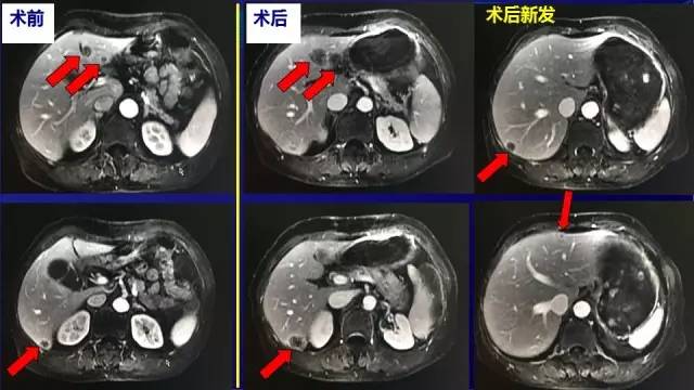 肠癌肝转移同时性和异时性,邢宝才治疗肠癌肝转移成功病例