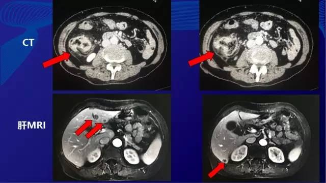 肠癌肝转移同时性和异时性,邢宝才治疗肠癌肝转移成功病例