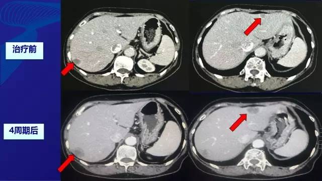 肠癌肝转移同时性和异时性,邢宝才治疗肠癌肝转移成功病例